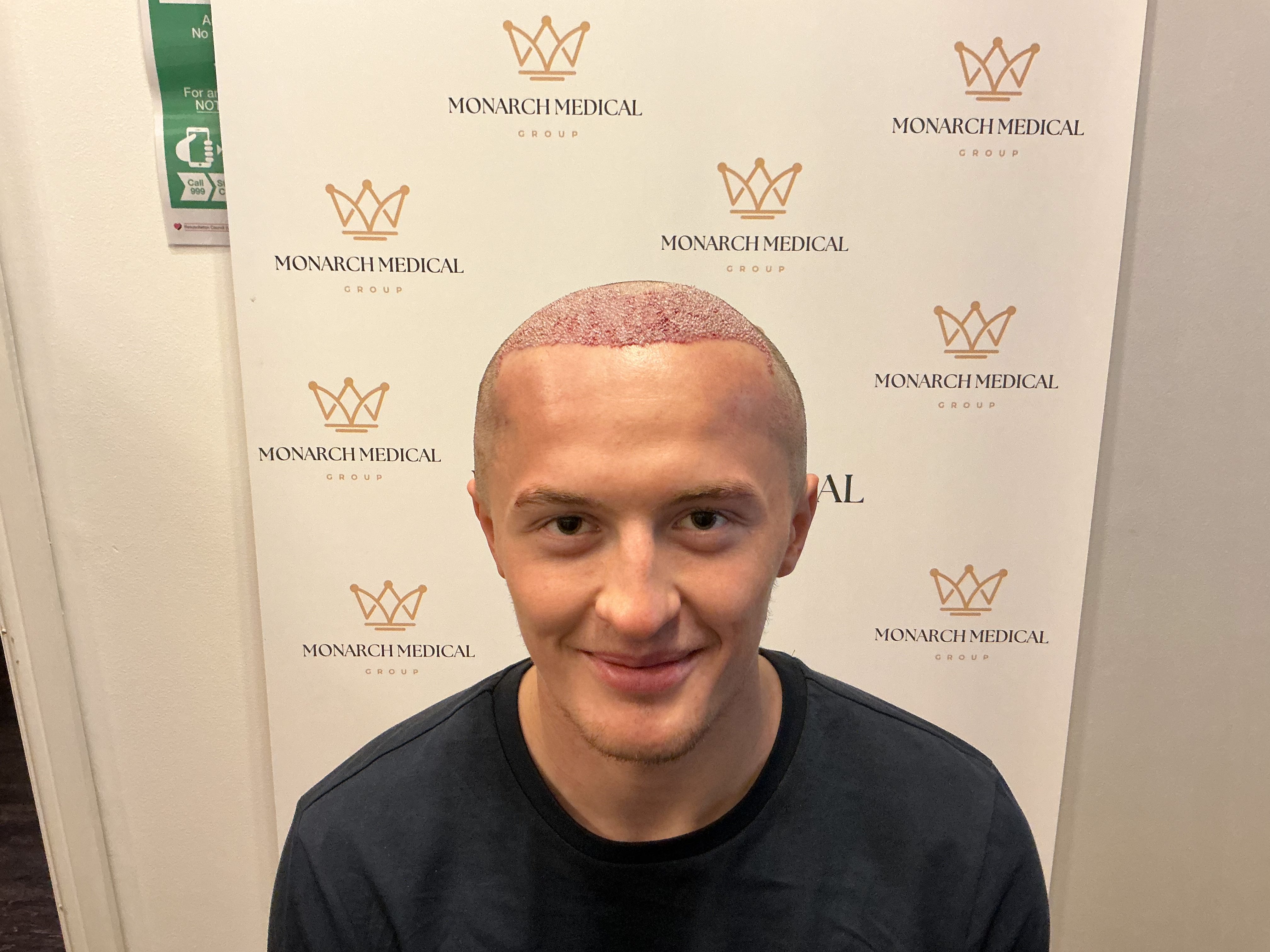 Advanced hairline recession — result photo 3
